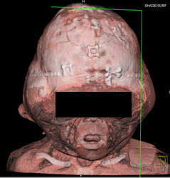 Cranial Deformity - CTisus CT Scan