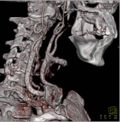 Carotid Artery Stenosis - CTisus CT Scan