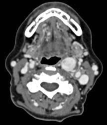 Paraganglioma- Carotid Body Tumors - CTisus CT Scan