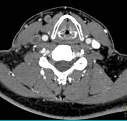 Jugular Vein Thrombosis - CTisus CT Scan