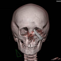 Foreign Body Through Orbit - CTisus CT Scan