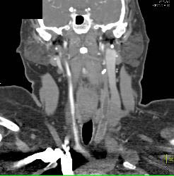 Jugular Vein Thrombosis - CTisus CT Scan