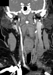 Jugular Vein Thrombosis - CTisus CT Scan