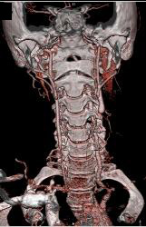 Jugular Vein Thrombosis - CTisus CT Scan