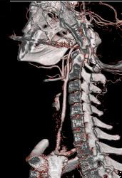 Carotid Artery Stenosis - CTisus CT Scan