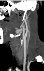 Normal Carotid Artery - CTisus CT Scan