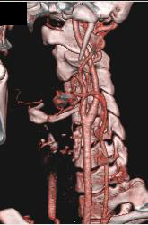 Normal Carotid Artery - CTisus CT Scan