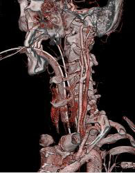 Normal Carotid Artery - CTisus CT Scan