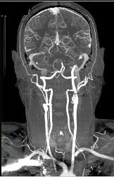 CTA With Dual Energy and Bone Removal - CTisus CT Scan