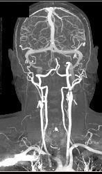 CTA With Dual Energy and Bone Removal - CTisus CT Scan