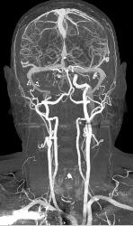 CTA With Dual Energy and Bone Removal - CTisus CT Scan