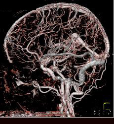 CTA With Dual Energy and Bone Removal - CTisus CT Scan