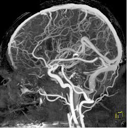 CTA With Dual Energy and Bone Removal - CTisus CT Scan