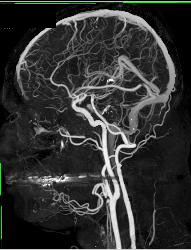 CTA With Dual Energy and Bone Removal - CTisus CT Scan