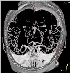 Normal Circle of Willis - CTisus CT Scan