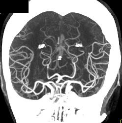 CTA With Dual Energy and Bone Removal - CTisus CT Scan