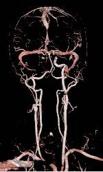 CTA With Dual Energy and Bone Removal - CTisus CT Scan