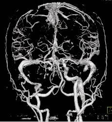 CTA With Dual Energy and Bone Removal - CTisus CT Scan