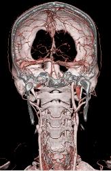 CTA With Dual Energy and Bone Removal - CTisus CT Scan