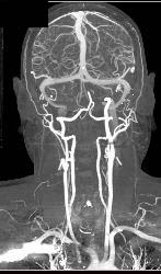 CTA With Dual Energy and Bone Removal - CTisus CT Scan