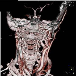 Ectatic Carotid Arteries in Loeys-Dietz Syndrome. Patient Also Has Stenosis to Origin of Left Subclavian Artery - CTisus CT Scan