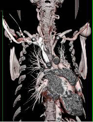 Ectatic Carotid Arteries in Loeys-Dietz Syndrome. Patient Also Has Stenosis to Origin of Left Subclavian Artery - CTisus CT Scan