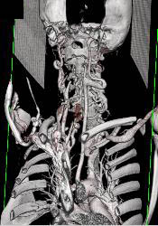 Ectatic Carotid Arteries in Loeys-Dietz Syndrome. Patient Also Has Stenosis to Origin of Left Subclavian Artery - CTisus CT Scan