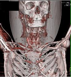 Ectatic Carotid Arteries in Loeys-Dietz Syndrome. Patient Also Has Stenosis to Origin of Left Subclavian Artery - CTisus CT Scan