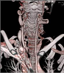 Ectatic Carotid Arteries in Loeys-Dietz Syndrome. Patient Also Has Stenosis to Origin of Left Subclavian Artery - CTisus CT Scan