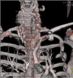 Ectatic Carotid Arteries in Loeys-Dietz Syndrome. Patient Also Has Stenosis to Origin of Left Subclavian Artery - CTisus CT Scan