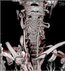 Ectatic Carotid Arteries in Loeys-Dietz Syndrome. Patient Also Has Stenosis to Origin of Left Subclavian Artery - CTisus CT Scan