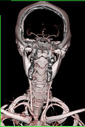 Circle of Willis and Basilar Artery - CTisus CT Scan