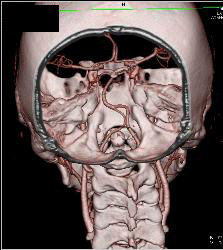 Circle of Willis and Basilar Artery - CTisus CT Scan