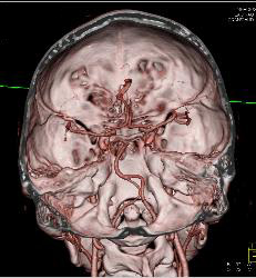 Circle of Willis and Basilar Artery - CTisus CT Scan