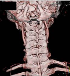 Circle of Willis and Basilar Artery - CTisus CT Scan