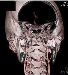 Circle of Willis and Basilar Artery - CTisus CT Scan