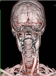 Circle of Willis and Basilar Artery - CTisus CT Scan