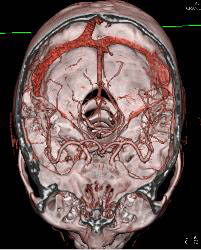 Circle of Willis - CTisus CT Scan