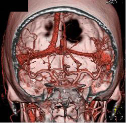 Circle of Willis - CTisus CT Scan