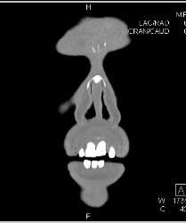 Mild Sinusitis - CTisus CT Scan