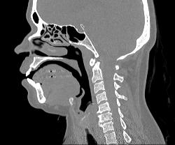 Mild Sinusitis - CTisus CT Scan