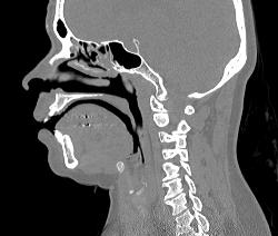 Mild Sinusitis - CTisus CT Scan