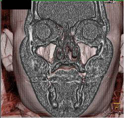 Mild Sinusitis - CTisus CT Scan