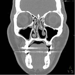 Mild Sinusitis - CTisus CT Scan