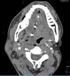 GSW Neck With Carotid Artery Injury - CTisus CT Scan