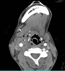 GSW Neck With Carotid Artery Injury - CTisus CT Scan