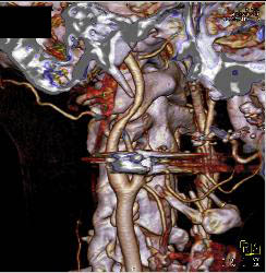 GSW Neck With Carotid Artery Injury - CTisus CT Scan