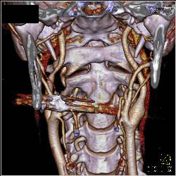 GSW Neck With Carotid Artery Injury - CTisus CT Scan