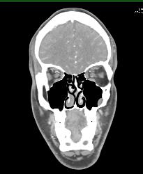 Deviated Septum - CTisus CT Scan