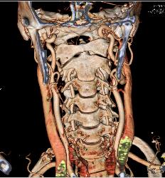 3D of Carotid and Vertebral Arteries - CTisus CT Scan